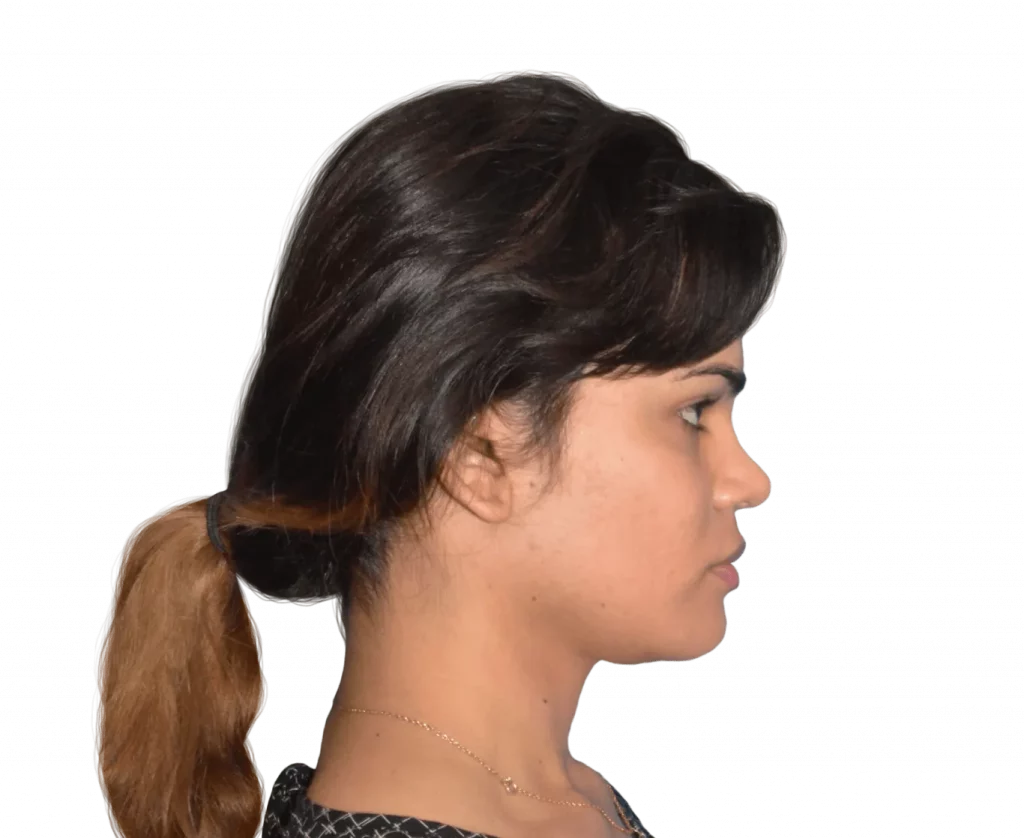 Picture taken from the side of Aline after surgery