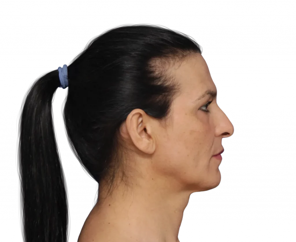 Picture taken from the side of Carmen before surgery