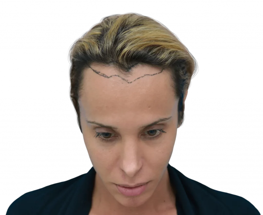 Frontal down picture taken from Carol before surgery