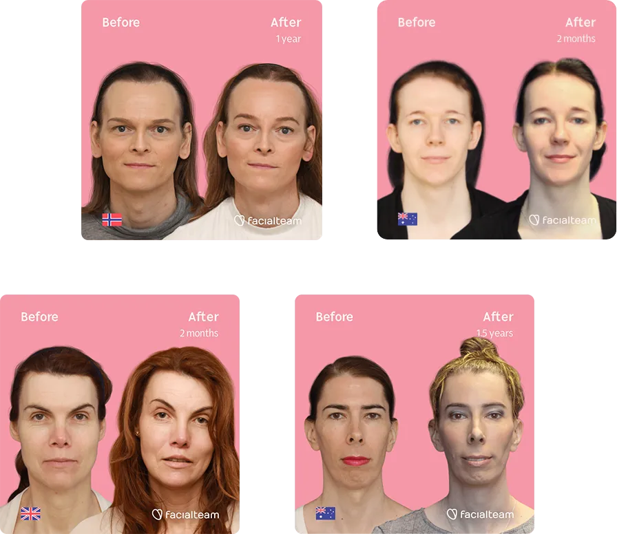 Zusammenstellung von 4 Facialteam FFS-Patientinnen, die die Ergebnisse ihrer Feminisierungsoperation im Gesicht vor und nach der Operation zeigen.