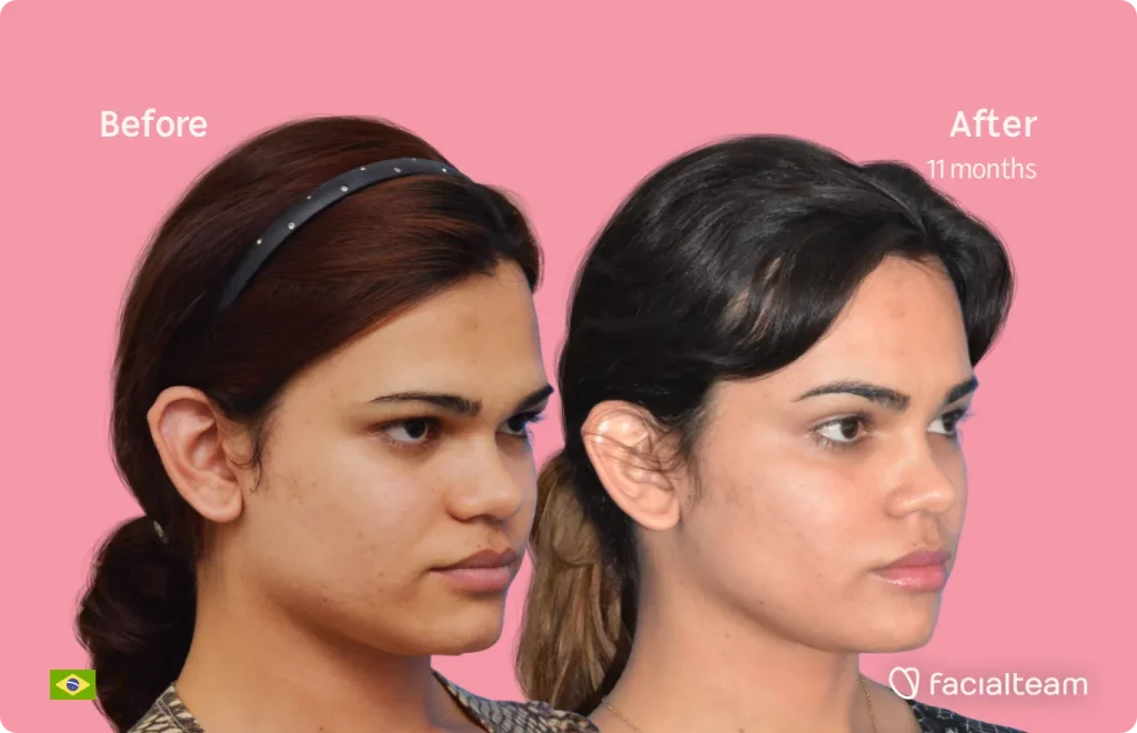 45-Grad-Aufnahme der FFS-Patientin Aline, die die Ergebnisse vor und nach der Gesichtsfeminisierung zeigt, die aus einer Operation zur Feminisierung von Stirn, Kiefer und Kinn besteht.
