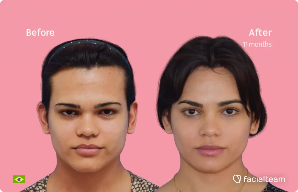 Die Frontalaufnahme der FFS-Patientin Aline zeigt die Ergebnisse vor und nach der Gesichtsfeminisierung mit Facialteam, bestehend aus einer Stirn-, Kiefer- und Kinnfeminisierung.