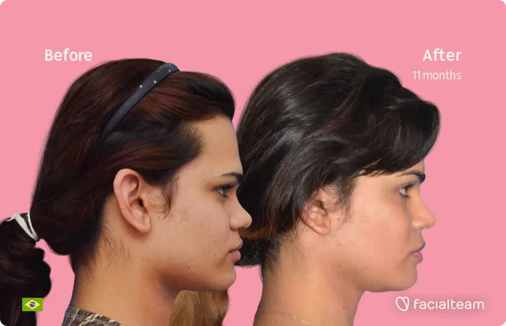 Seitenbild der FFS-Patientin Aline, das die Ergebnisse vor und nach der Feminisierungsoperation mit Facialteam zeigt, die aus einer Feminisierungsoperation an Stirn, Kiefer und Kinn besteht.