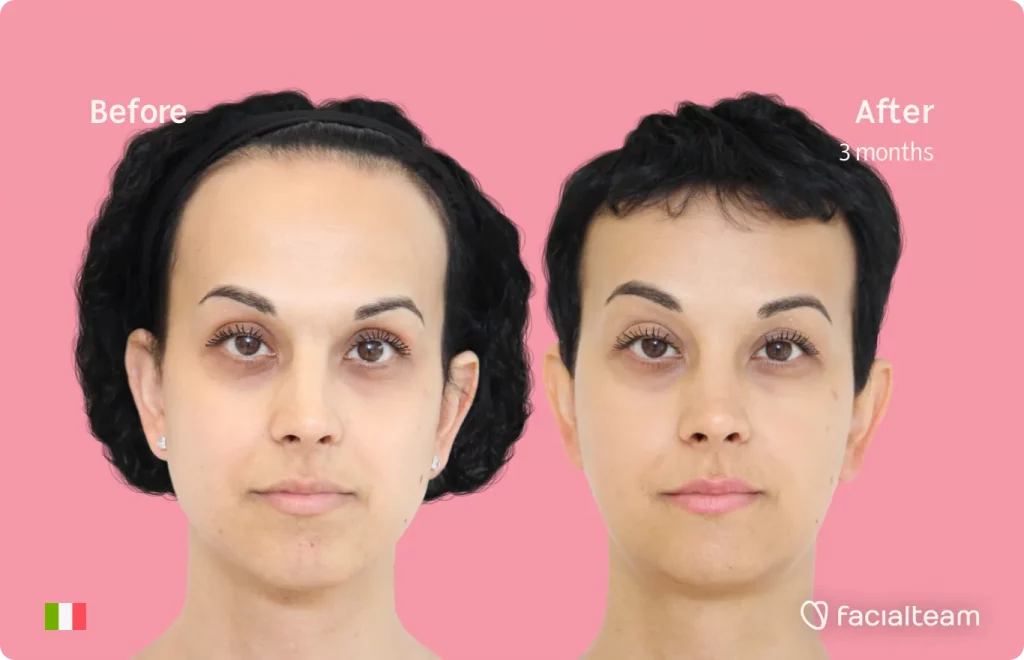Die Frontalaufnahme der Patientin Lory zeigt die Ergebnisse vor und nach der Feminisierungsoperation mit Facialteam, die eine Feminisierung von Stirn, Kiefer und Kinn beinhaltet.