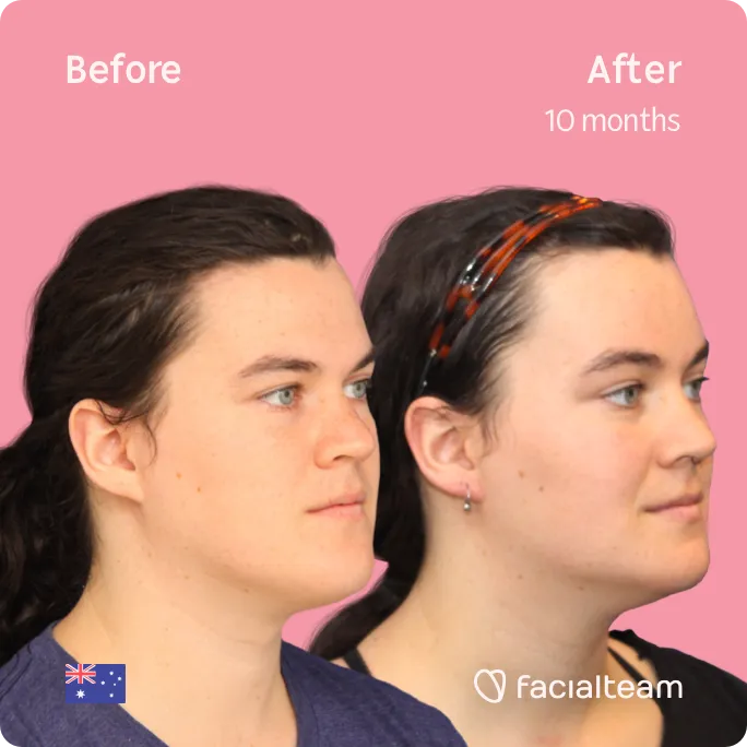 Das 45°-Quadratbild der Patientin FFS Winter zeigt die Ergebnisse vor und nach der gesichtsfeminisierenden Operation, die aus einer Stirn-, Kiefer- und Kinnfeminisierung besteht.