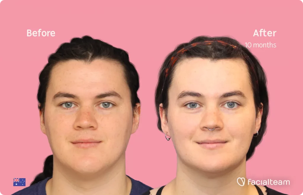 Frontalaufnahme der Patientin FFS Winter, die die Ergebnisse vor und nach der Feminisierungsoperation mit Facialteam zeigt, die aus einer Feminisierungsoperation an Stirn, Kiefer und Kinn besteht.