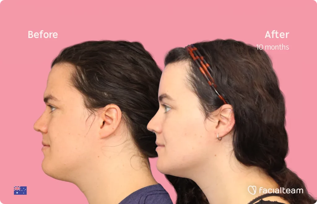 Seitenbild der FFS Winter-Patientin, das die Ergebnisse vor und nach der Feminisierungsoperation mit Facialteam zeigt, die aus einer Feminisierungsoperation an Stirn, Kiefer und Kinn besteht.