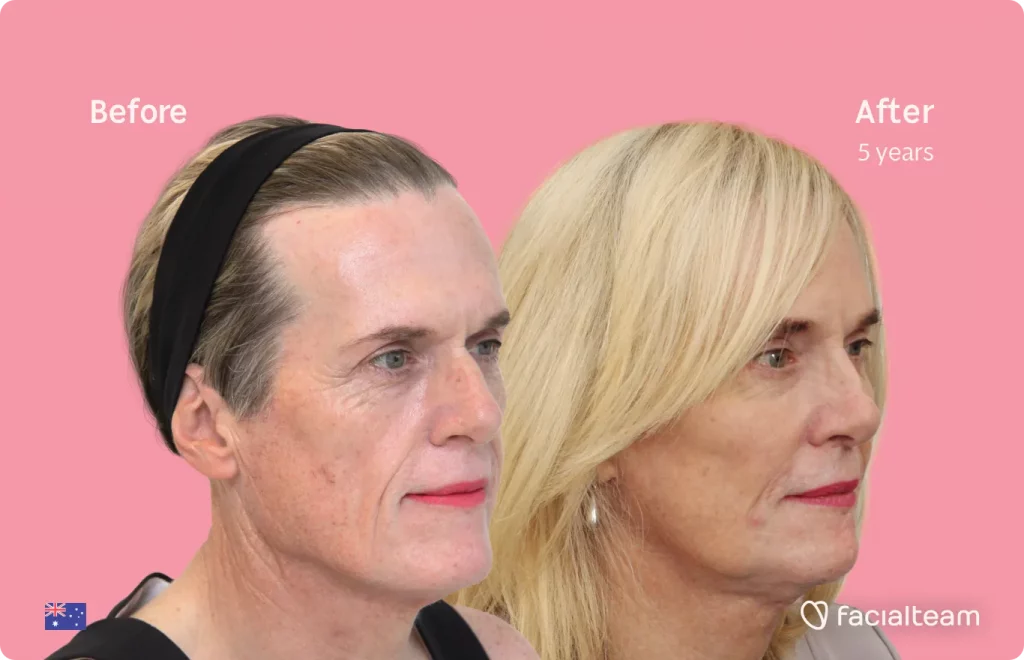 Die 45-Grad-Aufnahme der FFS-Patientin Alice zeigt die Ergebnisse vor und nach der Operation zur Gesichtsfeminisierung von Stirn, Kiefer und Kinn sowie der Nasenkorrektur.
