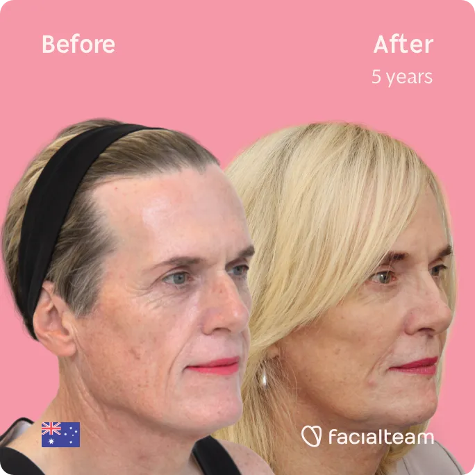 Quadratische 45-Grad-Aufnahme der FFS-Patientin Alice, die die Ergebnisse vor und nach der Feminisierung des Gesichts zeigt, bestehend aus Stirn-, Kiefer- und Kinnchirurgie, Rhinoplastik und Feminisierungsoperation.