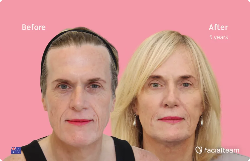 Die Frontalaufnahme der FFS-Patientin Alice zeigt die Ergebnisse vor und nach der gesichtsfeminisierenden Operation mit Facialteam bestehend aus Stirn, Kiefer und Kinn, Rhinoplastik und Feminisierungsoperation.