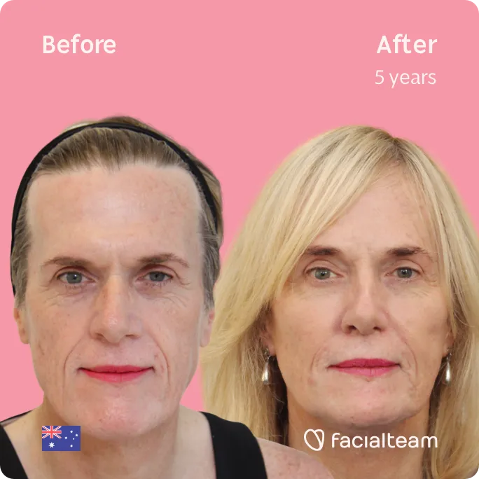 Quadratische Frontalaufnahme der FFS-Patientin Alice, die die Ergebnisse vor und nach der Feminisierungsoperation im Gesicht mit Facialteam bestehend aus Stirn, Kiefer und Kinn, Rhinoplastik und Feminisierungsoperation zeigt.