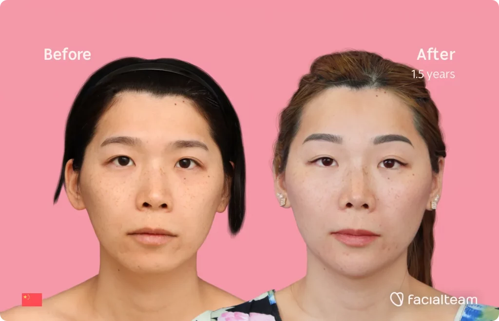 Die Frontalaufnahme der FFS-Patientin Harriet zeigt die Ergebnisse vor und nach der Feminisierungsoperation im Gesicht mit Facialteam bestehend aus Stirn, Kiefer und Kinn, Rhinoplastik und Feminisierungsoperation.