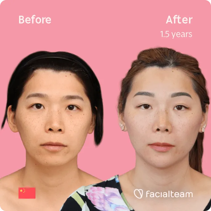 Quadratische Frontalaufnahme der FFS-Patientin Harriet, die die Ergebnisse vor und nach der Feminisierungsoperation im Gesicht mit Facialteam, bestehend aus Stirn, Kiefer und Kinn, und Rhinoplastik zeigt.