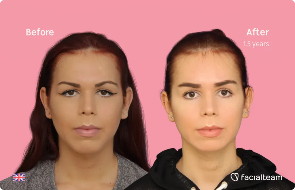 Frontalaufnahme der FFS-Patientin Wren, die die Ergebnisse vor und nach der Feminisierungsoperation mit Facialteam zeigt, die aus einer Feminisierungsoperation der Stirn, des Kiefers und des Kinns mit Trachealrasur besteht.