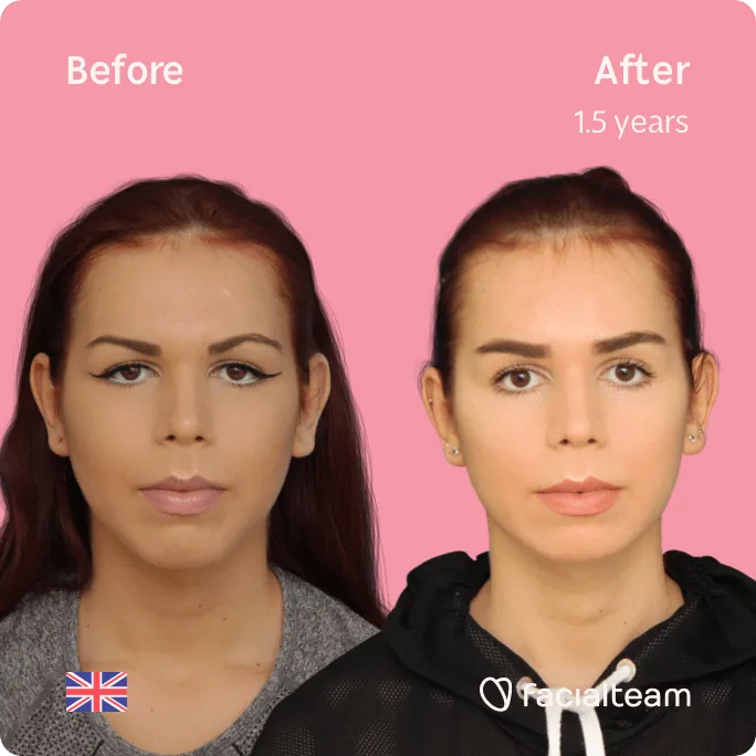 Imagen frontal cuadrada de la paciente Wren de FFS que muestra los resultados antes y después de la cirugía de feminización facial con Facialteam que consiste en la cirugía de feminización de la frente, la mandíbula y el mentón, con afeitado traqueal.