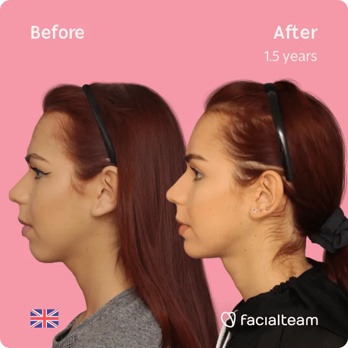 Quadratisches Seitenbild der FFS-Patientin Wren, das die Ergebnisse vor und nach der Facialteam-Gesichtsfeminisierungsoperation zeigt, die aus einer Stirn-, Kiefer- und Kinnfeminisierungsoperation mit Trachealrasur besteht.