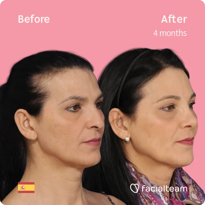 Quadratische 45-Grad-Aufnahme der FFS-Patientin Carmen, die die Ergebnisse vor und nach der Feminisierungsoperation des Gesichts zeigt, die aus einer Feminisierungsoperation der Stirn und einer Nasenkorrektur besteht.