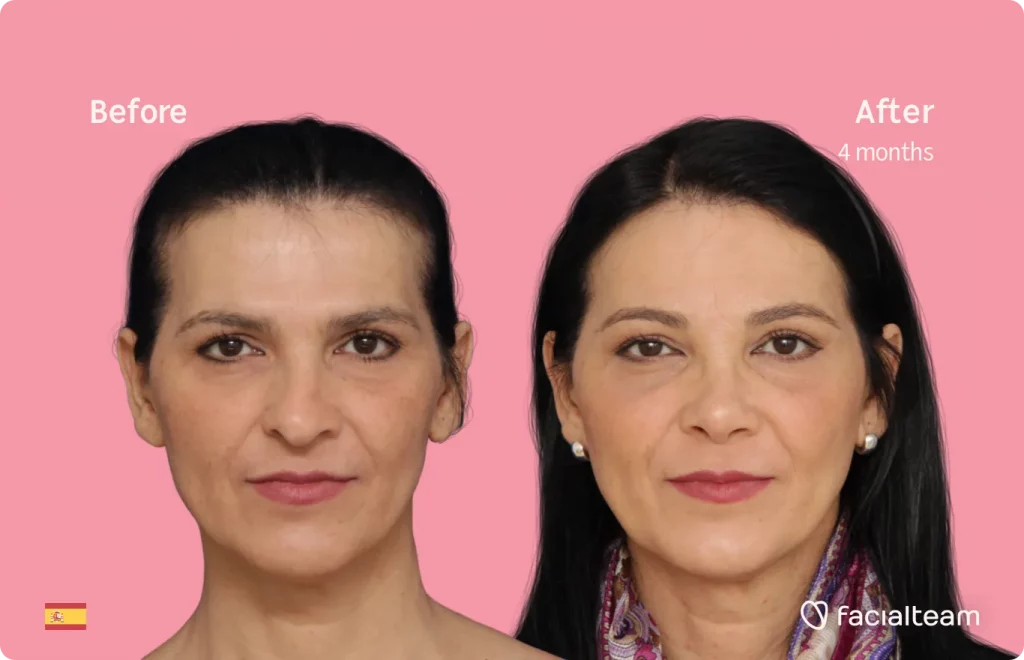 Die Frontalaufnahme der FFS-Patientin Carmen zeigt die Ergebnisse vor und nach der Feminisierungsoperation mit Facialteam, bestehend aus Stirn- und Nasenkorrektur.