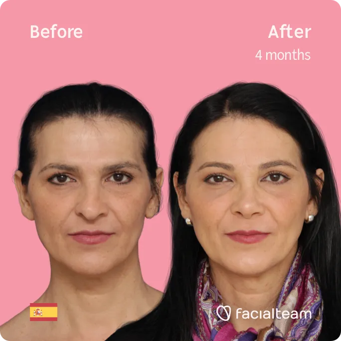 Quadratische Frontalaufnahme der FFS-Patientin Carmen, die die Ergebnisse vor und nach der Feminisierungsoperation mit Facialteam, bestehend aus Stirn, Rhinoplastik und Feminisierungsoperation, zeigt.