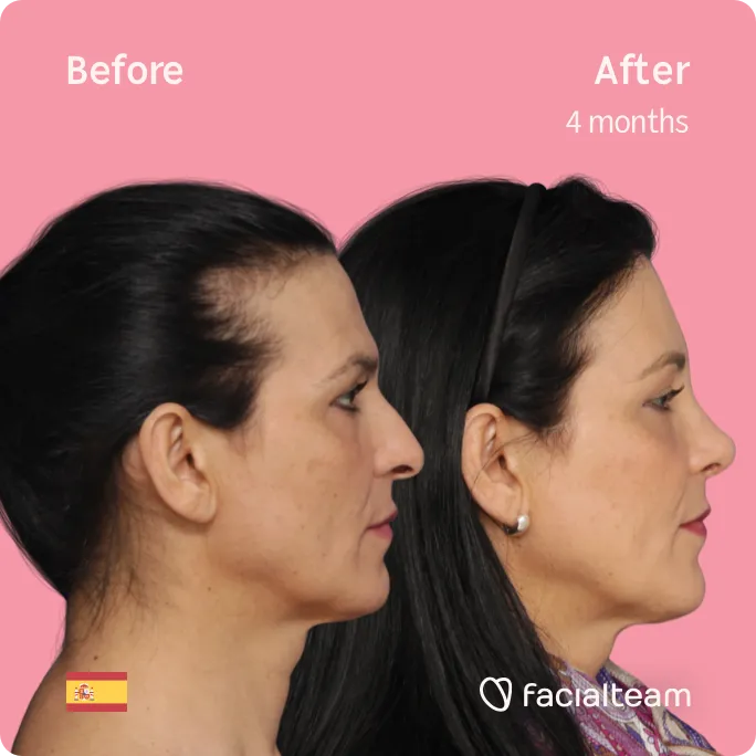 Quadratisches Seitenbild der FFS-Patientin Carmen, das die Ergebnisse vor und nach der Feminisierungsoperation mit Facialteam zeigt, die aus einer Feminisierungsoperation der Stirn und einer Nasenkorrektur besteht.