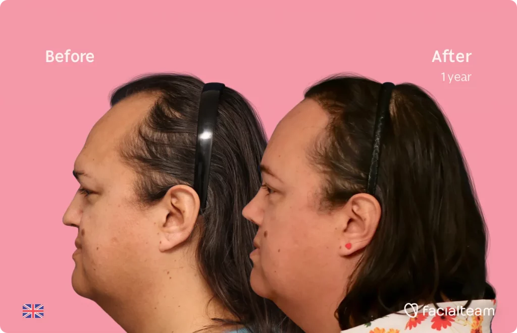 Seitenbild der FFS-Patientin Elodie, das die Ergebnisse vor und nach der Feminisierungsoperation mit Facialteam zeigt, die aus Stirn-, Nasenkorrektur- und Trachealrasur-Feminisierungsoperation besteht.