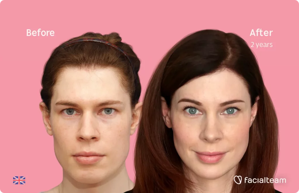 Frontalaufnahme der Patientin Charlotte W von FFS mit den Ergebnissen vor und nach der Feminisierungsoperation mit Facialteam, bestehend aus Feminisierungsoperation der Stirn, Nasenkorrektur, Trachealrasur, Kiefer und Kinn.