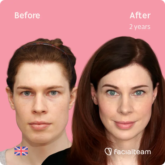 Imagen frontal cuadrada de la paciente Charlotte W de FFS que muestra los resultados antes y después de la cirugía de feminización facial con Facialteam que consiste en cirugía de feminización de la frente, rinoplastia, rasurado traqueal, mandíbula y mentón.