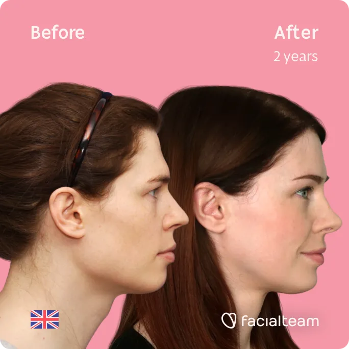 Imagen de lado cuadrado de la paciente Charlotte W de FFS que muestra los resultados antes y después de la cirugía de feminización facial con Facialteam que consiste en cirugía de feminización de la frente, rinoplastia, rasurado traqueal, mandíbula y mentón.
