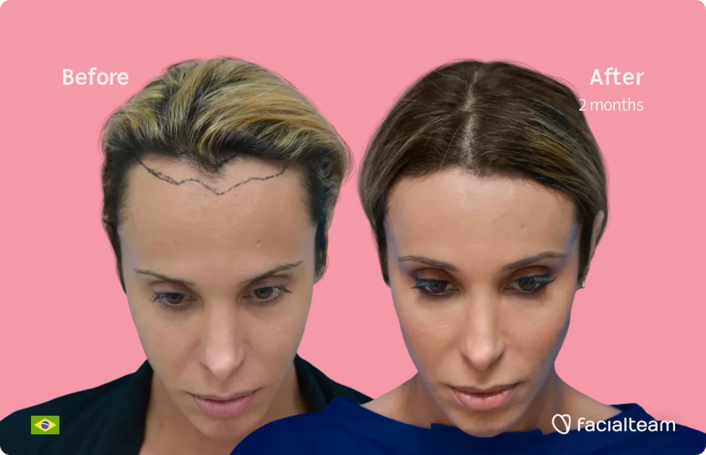 Die Frontalaufnahme der FFS-Patientin Carol zeigt die Ergebnisse vor und nach der gesichtsfeminisierenden Operation mit Facialteam, bestehend aus Stirn-, Trachealrasur- und Feminisierungsoperation.