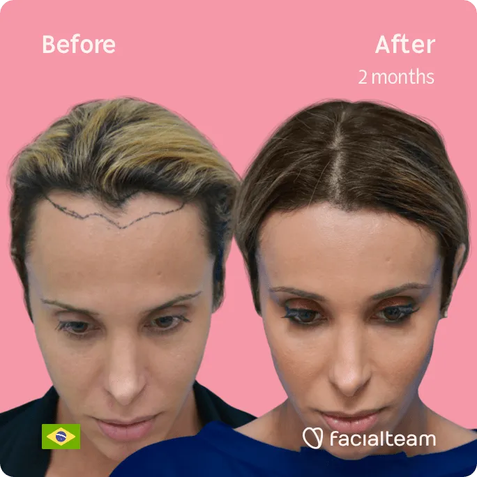 Quadratische Frontalaufnahme der FFS-Patientin Carol, die die Ergebnisse vor und nach der Feminisierungsoperation mit Facialteam zeigt, die aus einer Feminisierungsoperation an der Stirn und einer Trachealrasur besteht.
