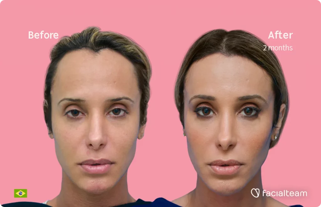 Die Frontalaufnahme der FFS-Patientin Carol zeigt die Ergebnisse vor und nach der Feminisierungsoperation mit dem Facialteam, das aus einer Feminisierungsoperation an der Stirn und einer Trachealrasur besteht.