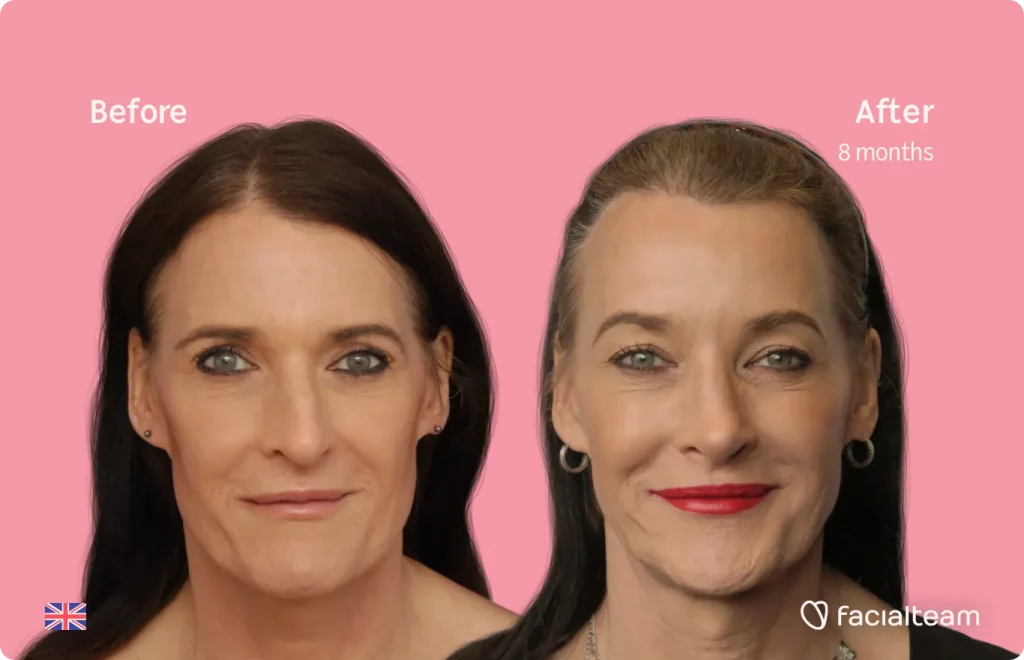 Frontalaufnahme der FFS-Patientin Susan, die die Ergebnisse vor und nach der Feminisierungsoperation im Gesicht mit Facialteam, bestehend aus Kiefer- und Kinnoperation, Rhinoplastik und Feminisierungsoperation an der Stirn zeigt.