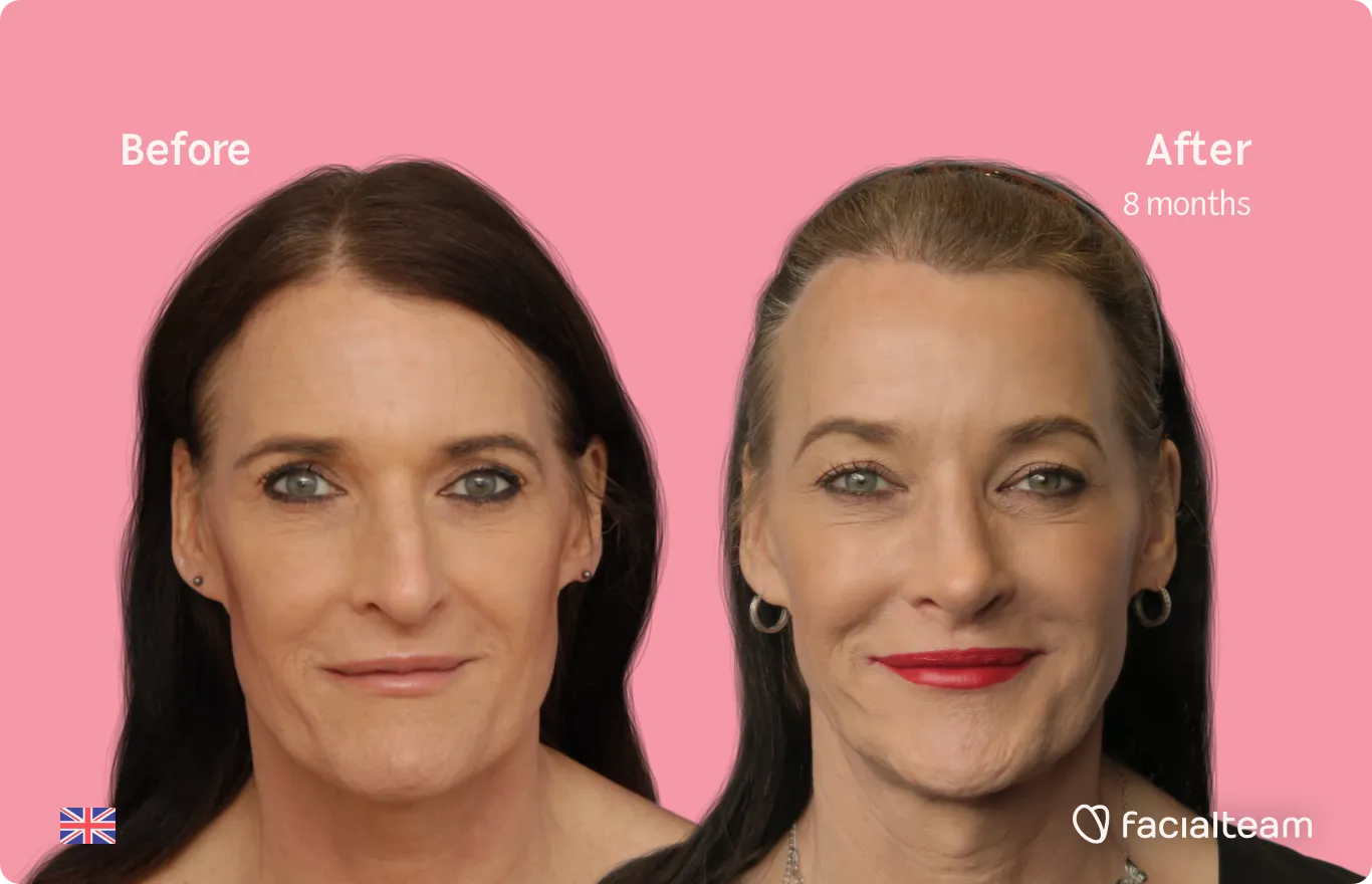 Frontalaufnahme der FFS-Patientin Susan, die die Ergebnisse vor und nach der Feminisierungsoperation im Gesicht mit Facialteam, bestehend aus Kiefer- und Kinnoperation, Rhinoplastik und Feminisierungsoperation an der Stirn zeigt.
