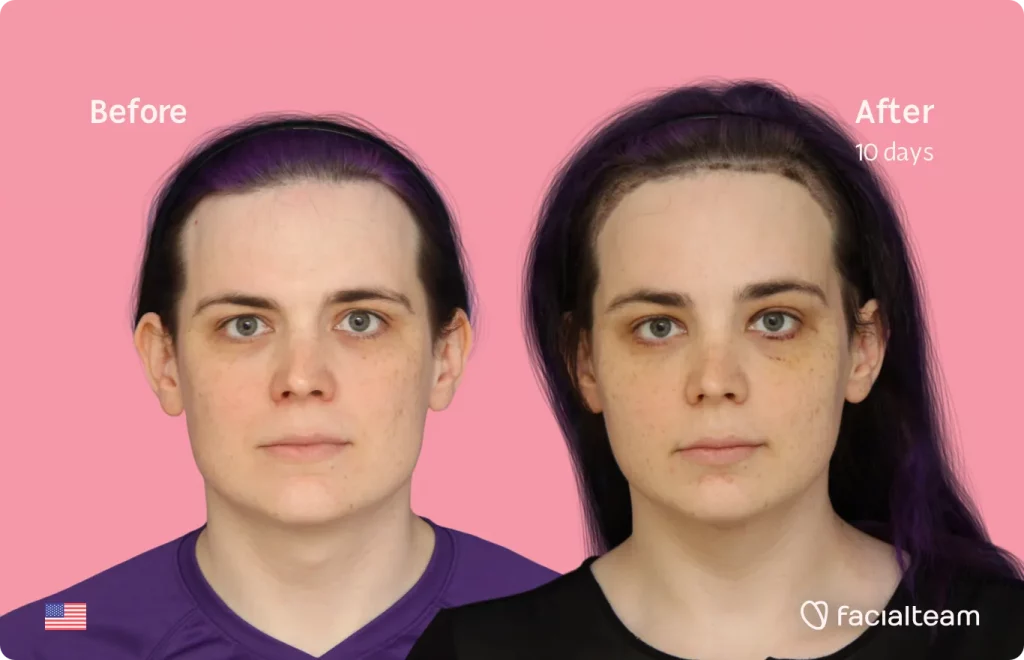 Frontalaufnahme der FFS-Patientin Téa, die die Ergebnisse vor und nach der Feminisierungsoperation mit Facialteam zeigt, die aus einer Trachealrasur sowie einer Feminisierungsoperation an Stirn, Kiefer und Kinn besteht.
