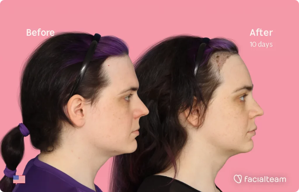 Seitenbild der FFS-Patientin Téa mit den Ergebnissen vor und nach der Feminisierungsoperation mit Facialteam, bestehend aus Trachealrasur, Stirn-, Kiefer- und Kinnfeminisierungsoperation.