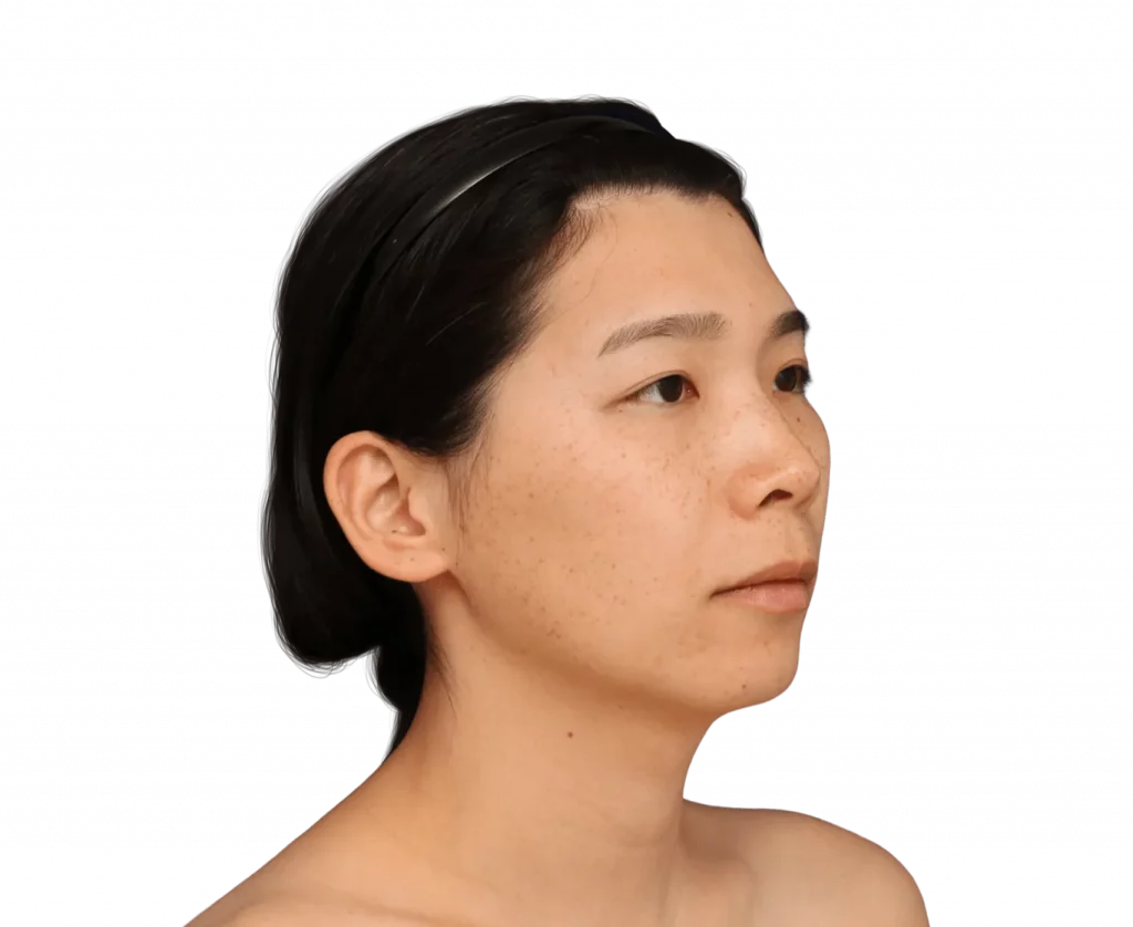 Picture taken at a 45 degree angle from Harriet before surgery