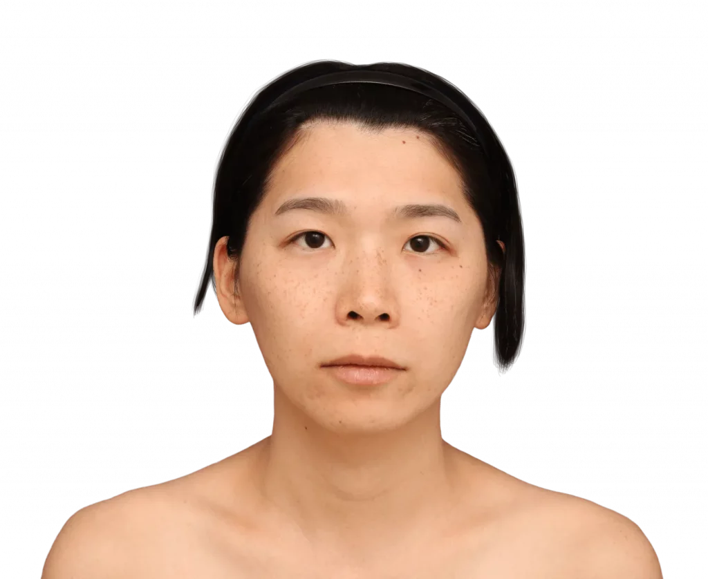 Frontal picture taken from Harriet before surgery