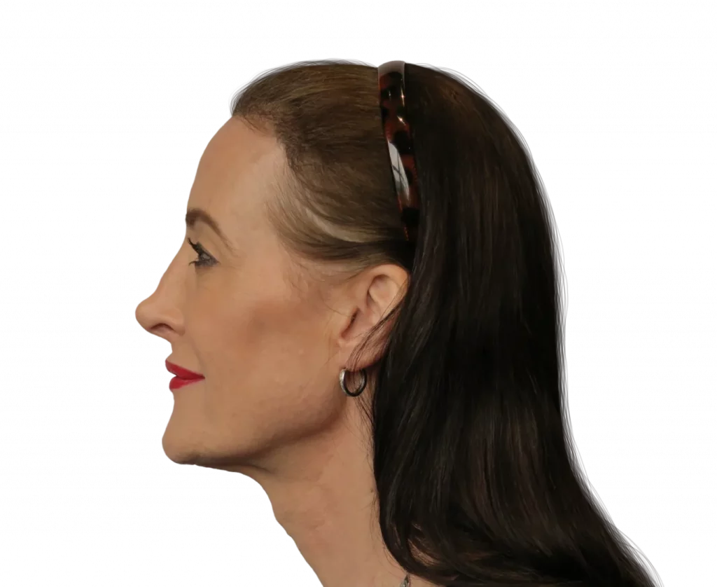 Picture taken from the side of Susan after surgery