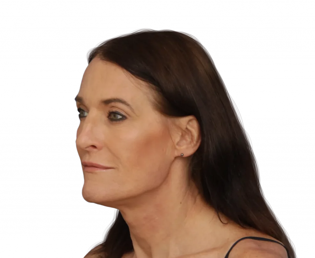 Picture taken at a 45 degree angle from Susan before surgery