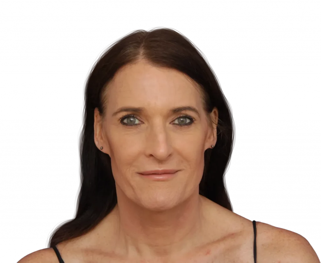 Frontal picture taken from Susan before surgery