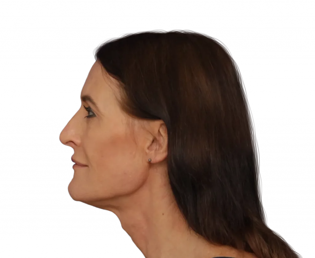 Picture taken from the side of Susan before surgery