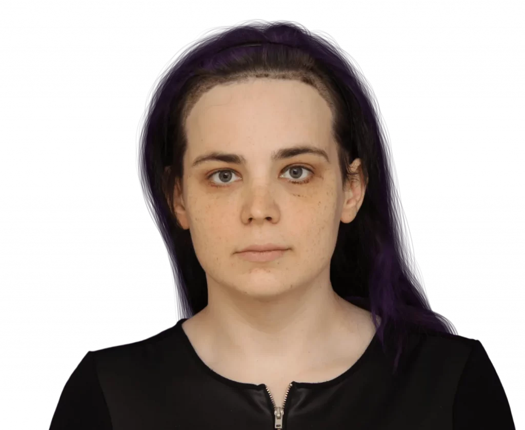 Frontal picture taken from Téa after surgery