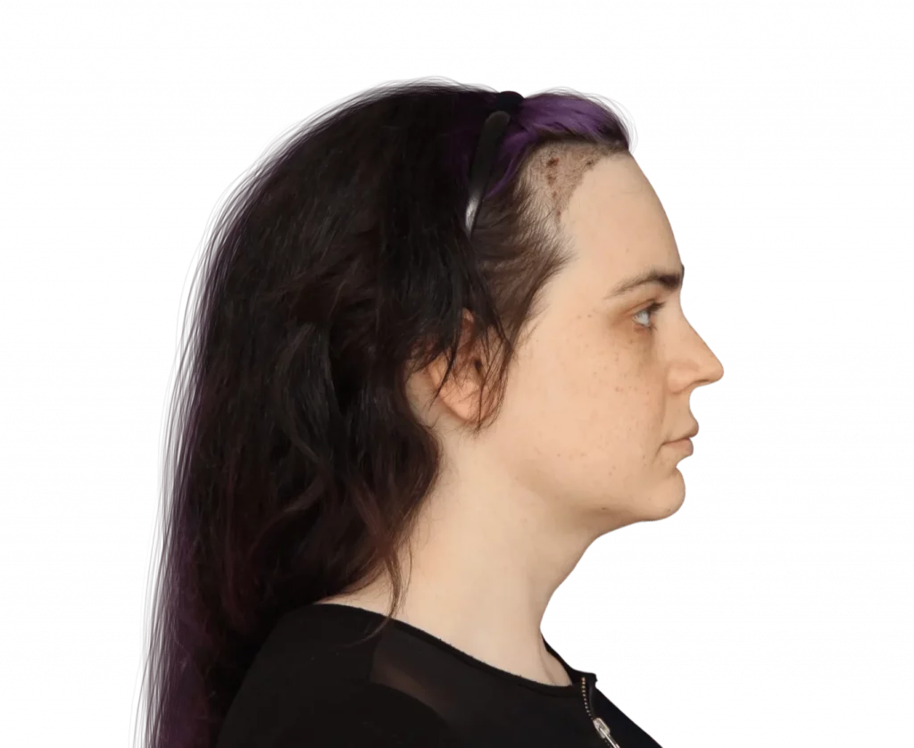 Picture taken from the side of Téa after surgery