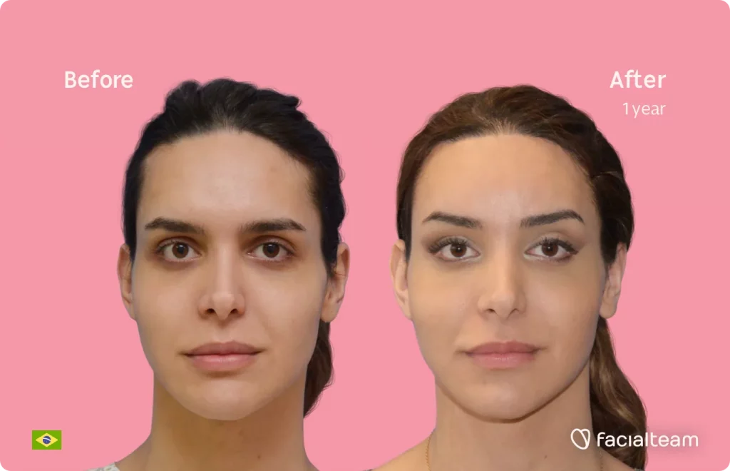 Die Frontalansicht von Viviany, einer FFS-Patientin, zeigt die Ergebnisse vor und nach der Feminisierungsoperation mit Facialteam, die aus einer Feminisierungsoperation an der Stirn, einer Luftröhrenrasur, dem Kiefer und dem Kinn besteht.