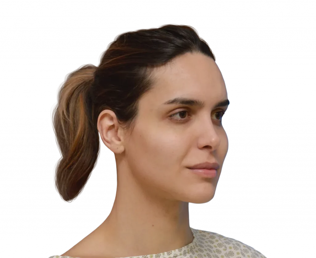 Foto tomada en un ángulo de 45 grados de Viviany antes de la cirugía