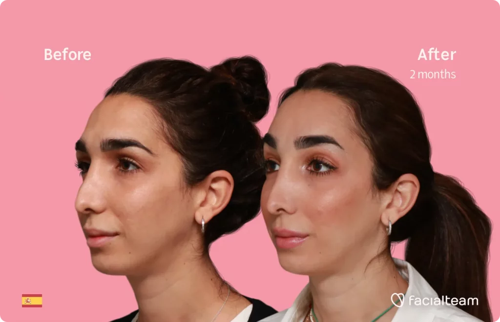 45 Grad linkes Bild der FFS-Patientin Lola, das die Ergebnisse vor und nach der Feminisierungsoperation im Gesicht zeigt, die aus einer Feminisierungsoperation der Stirn besteht.