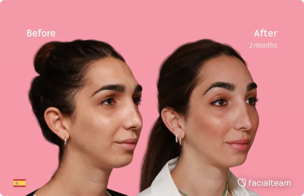 Das 45-Grad-Bild rechts von FFS-Patientin Lola zeigt die Ergebnisse vor und nach der Gesichtsfeminisierung, die aus einer Feminisierungsoperation der Stirn besteht.