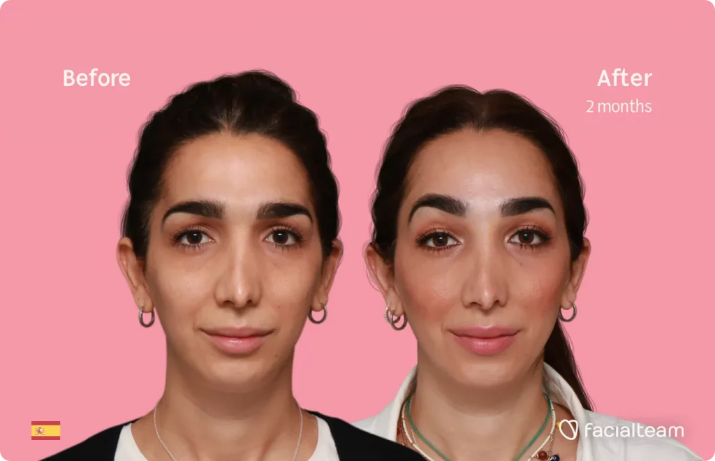 Frontalaufnahme der FFS-Patientin Lola, die das Ergebnis vor und nach der Feminisierungsoperation mit Facialteam zeigt, die eine Feminisierung der Stirn beinhaltet.
