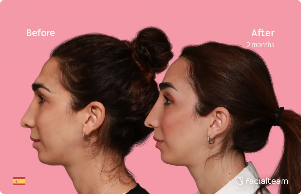 Imagen del lado izquierdo de Lola, paciente de FFS, que muestra los resultados antes y después de la cirugía de feminización facial con Facialteam que consiste en la cirugía de feminización de la frente.