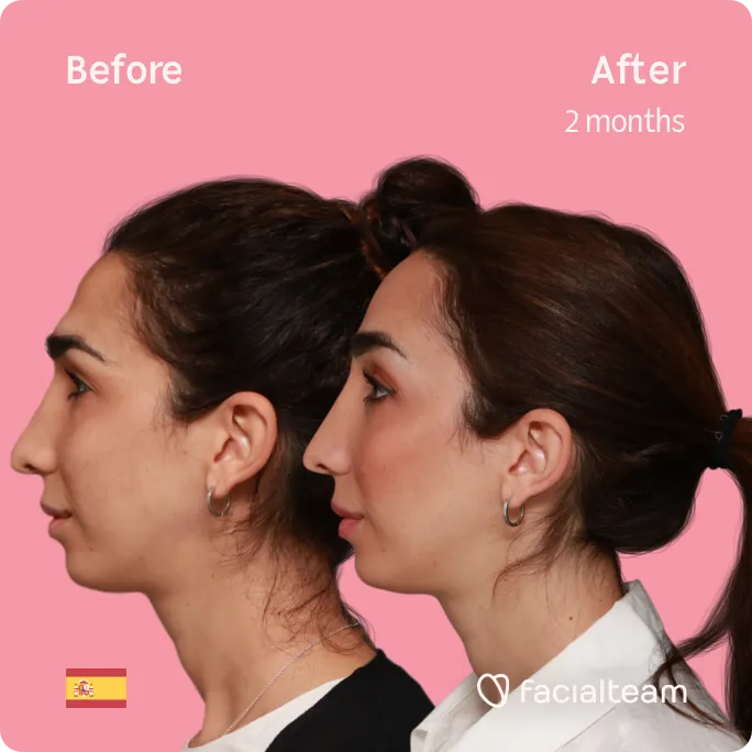 Das quadratische Bild der FFS-Patientin Lola auf der linken Seite zeigt die Ergebnisse vor und nach der Gesichtsfeminisierung mit Facialteam, die eine Feminisierung der Stirn beinhaltet.